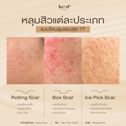 ระดับความรุนแรงของ หลุมสิว