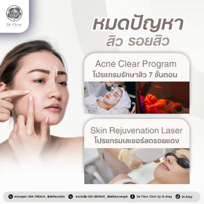 โปรแกรมรักษาสิว เคลียร์ทุกปัญหาผิว เพื่อผิวใสมั่นใจ ต้องเดอเฟลอร์คลินิก