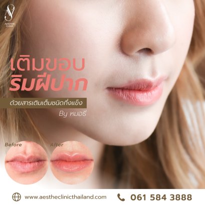 ฟิลเลอร์ปาก ให้ดูอวบอิ่ม อย่างเป็นธรรมชาติ - Aesthe Clinic