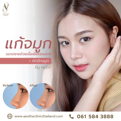 แก้จมูก ตัดปีกจมูกลดความบาน รองปลายด้วยเนื้อเยื่อธรรมชาติ เพิ่มมิติ - Aesthe Clinic 