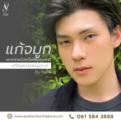 แก้จมูก + ตะไบฮัมพ์ รองปลายจมูกด้วยเนื้อเยื่อธรรมชาติ เพิ่มมิติใบหน้า  - Aesthe Clinic