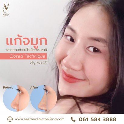 แก้จมูก + ตัดปีกจมูก ลดความบาน รองปลายจมูกด้วยเนื้อเยื่อธรรมชาติ - Aesthe Clinic