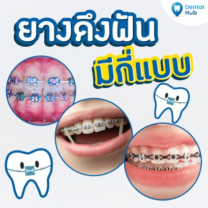 ยางจัดฟันมีกี่แบบ?