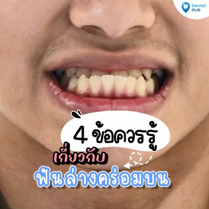 ฟันคร่อมควรแก้ไขก่อนอายุเท่าไหร่?