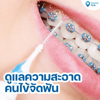 ดูแลความสะอาดคนไข้จัดฟัน