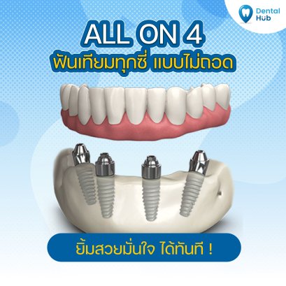 All on 4 ฟันเทียมทุกซี่แบบไม่ถอด