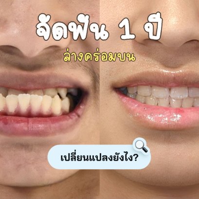ฟันหน้าคร่อม ปีแรก เห็นความเปลี่ยนแปลงอย่างไรบ้าง?