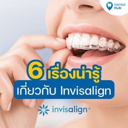 6 เรื่องน่ารู้เกี่ยวกับ Invisalign