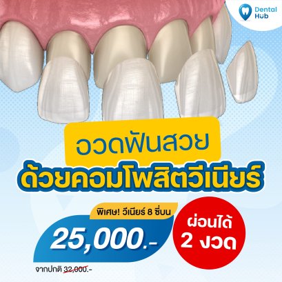 อวดฟันสวย ด้วยคอมโพสิตวีเนียร์