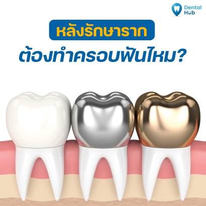 หลังรักษารากต้องทำครอบฟันไหม