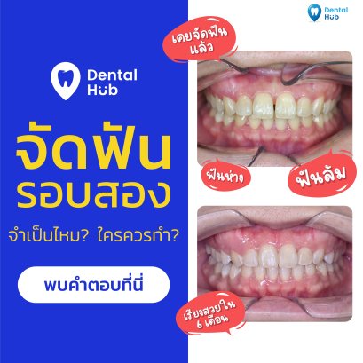 การจัดฟันรอบ 2 จำเป็นไหม? ใครควรทำ?