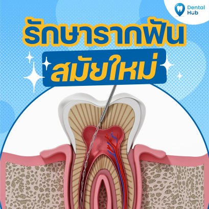 รักษารากฟันสมัยใหม่