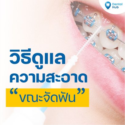 วิธีดูแลความสะอาดขณะจัดฟัน