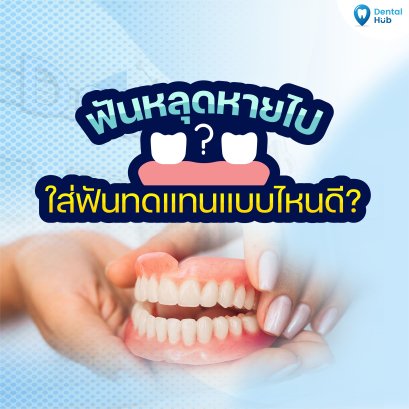 ฟันหลุดหายไป ใส่ฟันทดแทนแบบไหนดี?
