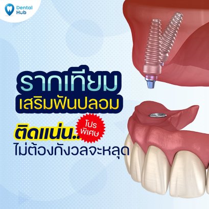 ฟันปลอมแบบใช้รากฟันเทียมเสริม