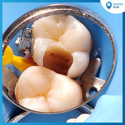 ปวดฟัน รักษายังไง 