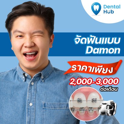 จัดฟันแบบดาม่อน
