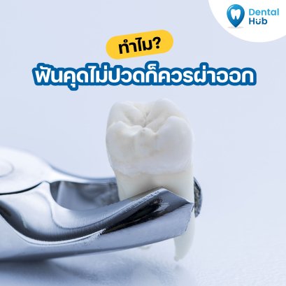 ทำไมฟันคุด ไม่ปวดก็ควรเอาออก