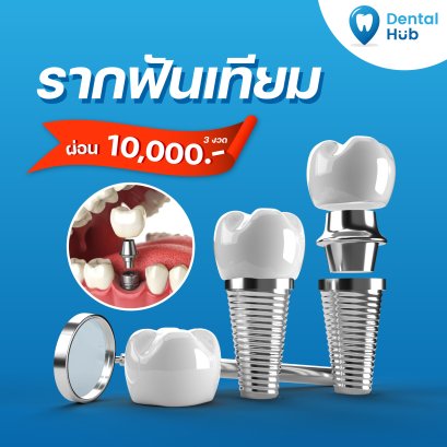 รากฟันเทียม โปรโมชั่นพิเศษ