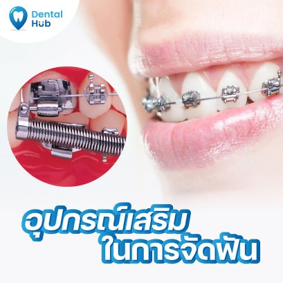 อุปกรณ์เสริมในการจัดฟัน