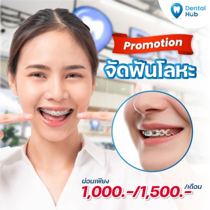 โปรโมชั่นจัดฟันแบบเหล็ก เริ่มต้น 500 บาท