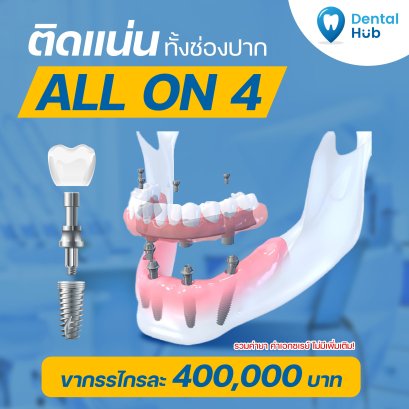 รากฟันเทียมทั้งปากแบบ All on 4