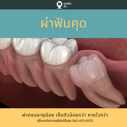 ผ่าฟันคุดสำคัญอย่างไร? ขั้นตอนเป็นยังไง?