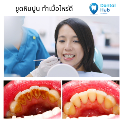 ทำไมต้องขูดหินปูน