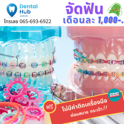 โปรจัดฟัน 1,000 บาท ผ่อนเบา แถมคุ้ม เริ่มต้นสบาย