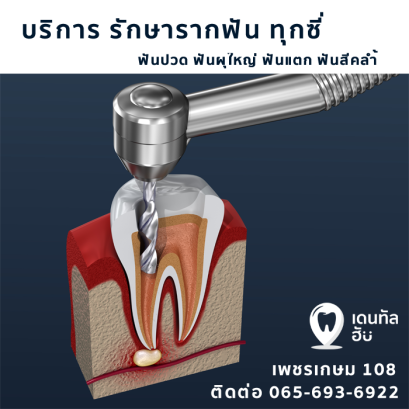 รับ รักษารากฟัน ทุกซี่ มีคุณหมอเฉพาะทางดูแล
