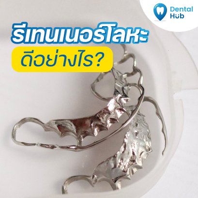 รีเทนเนอร์โลหะ ดีอย่างไร