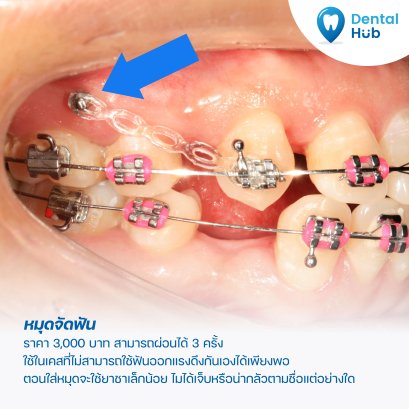 หมุดจัดฟัน คืออะไร