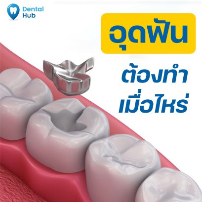 อุดฟันต้องทำเมื่อไหร่?