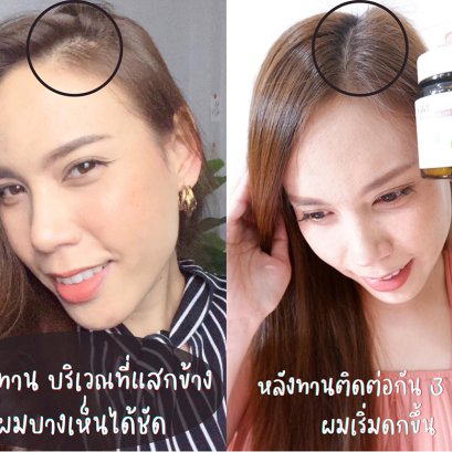 อาหารเสริมเส้นผมเพื่อผู้หญิง สรุป !! มันเวิร์ค เห้ยเอาจิง ไรผมเริ่มขึ้น
