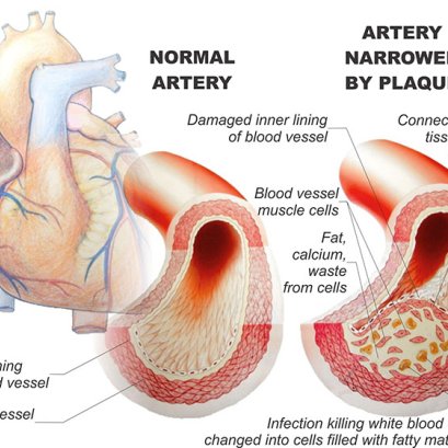 Chelation IV Detox ล้างหลอดเลือด ไล่สารพิษโลหะหนัก