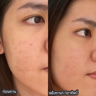 ผิวใสง่าย ๆ รอยสิวเดินหนี แค่ทาน Harris วันละ1เม็ด