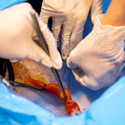 การพัฒนาทีมผ่าตัดนำไตออกจากผู้บริจาคที่เสียชีวิตด้วยภาวะสมองตาย ในเขตสุขภาพ