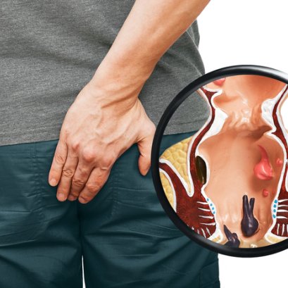 เพชรสังฆาต สมุนไพรรักษาริดสีดวงให้หายขาด