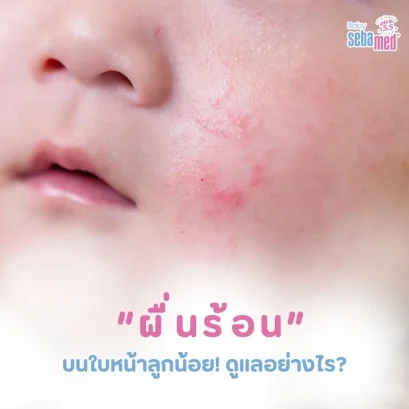 ผื่นร้อน