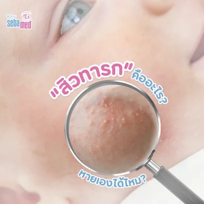 สิวทารกคืออะไร