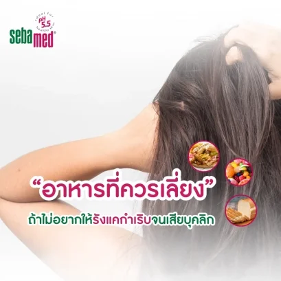 อาหารที่ควรเลี่ยง_ถ้าไม่อยากให้รังแคกำเริบจนเสียบุคลิก.