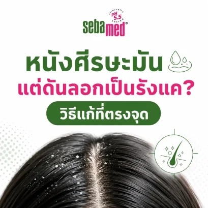 หนังศีรษะมัน_แต่ดันลอกเป็นรังแค_วิธีแก้ที่ตรงจุด