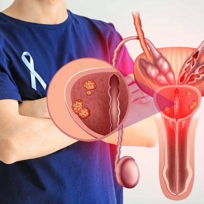 แนวทางปฎิบัติตัวเมื่อเป็นต่อมลูกหมากโต