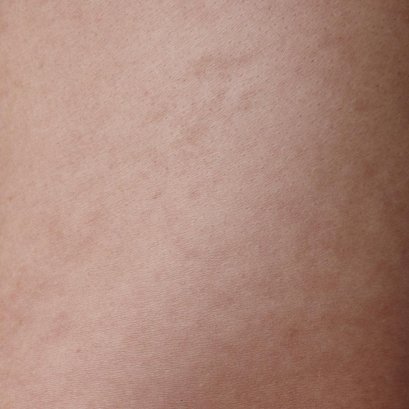 ปัญหาผิวหมองคล้ำ สีผิวไม่สม่ำเสมอ  