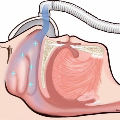 อันตรายและข้อควรระวังจากการใช้ CPAP โดยไม่ได้พบแพทย์