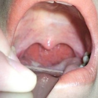 การร้อยไหมตกแต่งลิ้นไก่เพดานอ่อนและคอหอย แก้นอนกรน