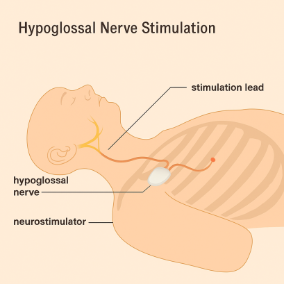 5 Things to Know Before Treating OSA with Inspire UAS