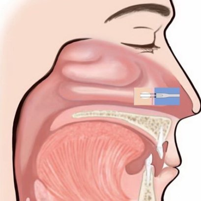 การใช้คลื่นความถี่วิทยุจี้เยื่อบุจมูก แก้คัดจมูก นอนกรน