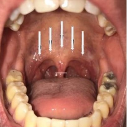 เปรียบเทียบการจี้คลื่นความถี่วิทยุ vs เลเซอร์รักษานอนกรน 
