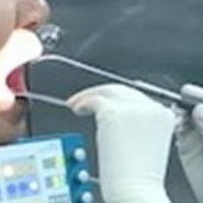 การใช้คลื่นความถี่วิทยุหลายระดับ รักษานอนกรน 